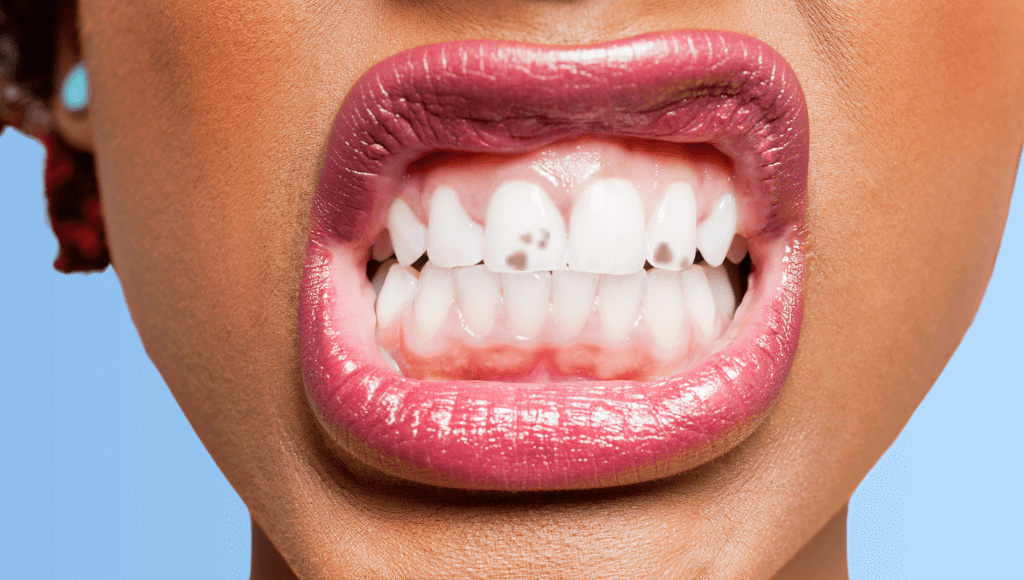 elfbar nachfll pod luft aus Langue noire et villeuse: causes, symptmes et traitements