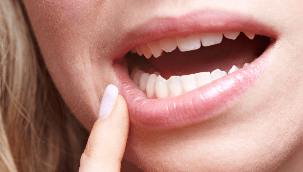 Tout savoir sur le tartre sous-gingival : causes, traitement et prévention Image