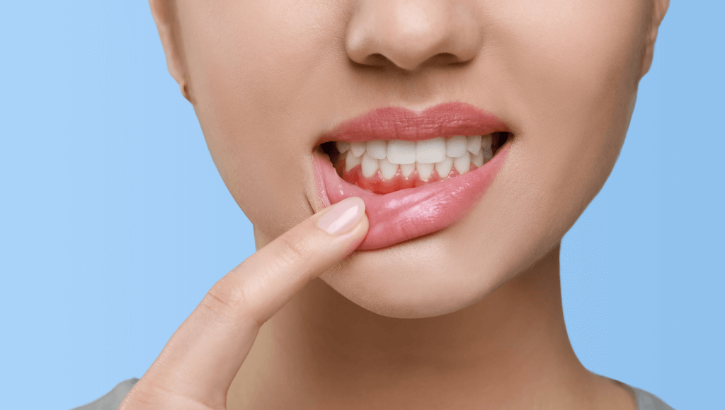 récession gingivale Image