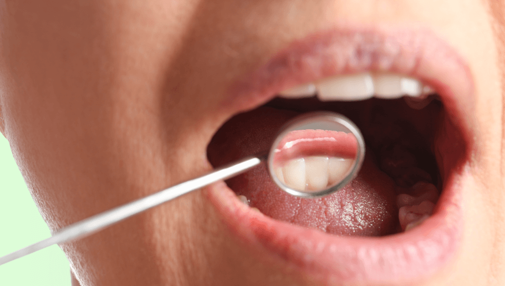 Papillite sur la langue Afbeelding