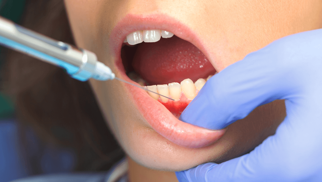 Mains avec gants en caoutchouc bleu en train de piquer la gencive inférieure d'une personne avec une seringue en métal Image