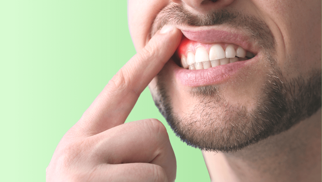Gencive gonflée : causes, traitements et prévention - Conseils de dentistes Image